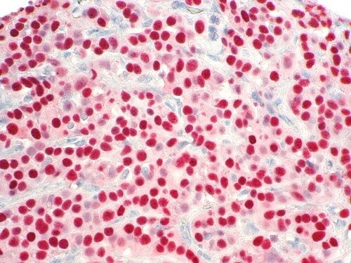Progesterone Receptor (PR) Rmab Antibody Immunohistochemistry on a FFPE Breast Carcinoma Tissue